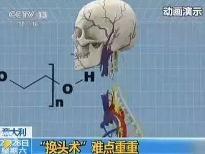 逆天了！世界首例人尸换头手术在中国成功实施！（组图） - 2