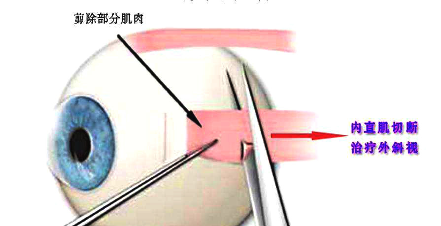 斜視手術後注意事項都要注意什麼
