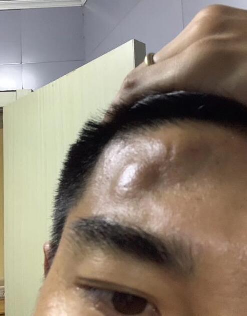 心疼孙世林!额头肿成大包被喷假摔演戏 向裁判申诉还吃黄牌