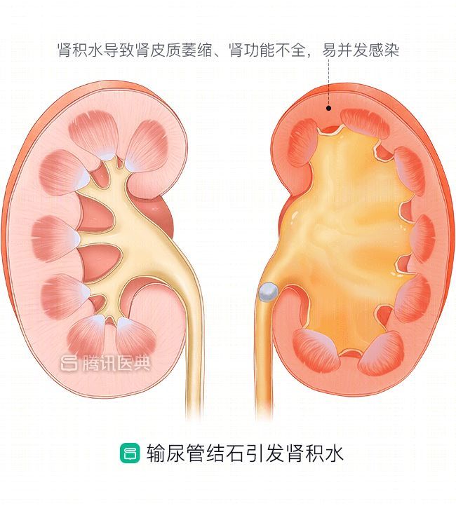 来源:腾讯医典医学插画最后,医生采用输尿管镜进行插管引流,将体内的