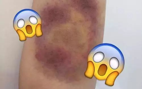 最近因为身体莫名出现青紫情况,无论白天黑夜!