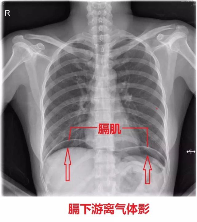 膈肌幕状粘连x线图片图片