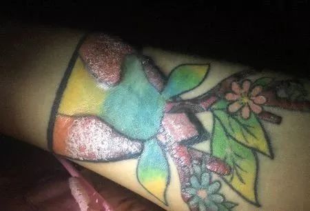 纹身出现排异该怎么做?