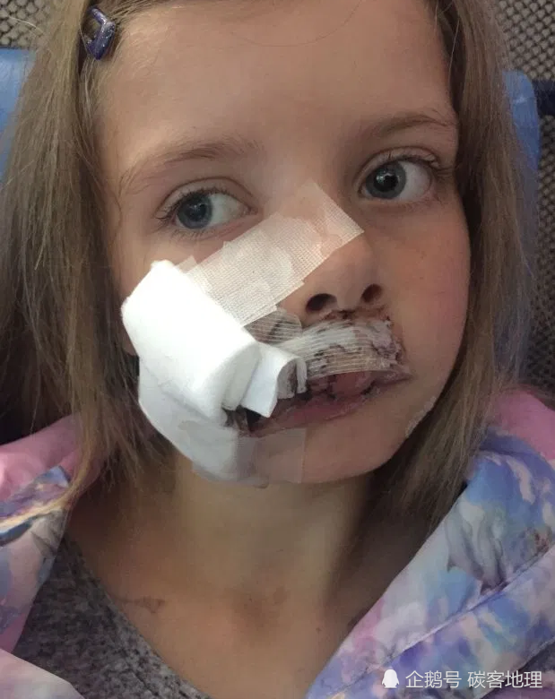 漂亮的9岁女孩被拉布拉多犬咬伤脸230多针,终生毁容