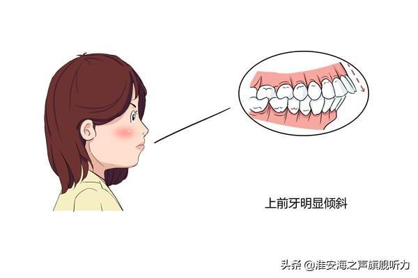 自己如何判斷下巴是否後縮來看看|下頜後縮|下巴