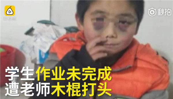 中国教育歧视观察： 安徽老师把小学生打成熊猫眼 教育局：立即调查