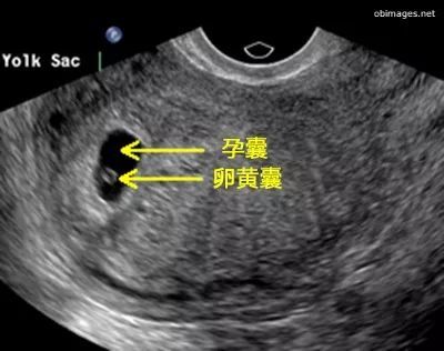 孕宝们捉摸不定的胎心胎芽 到底什么时候才会出现