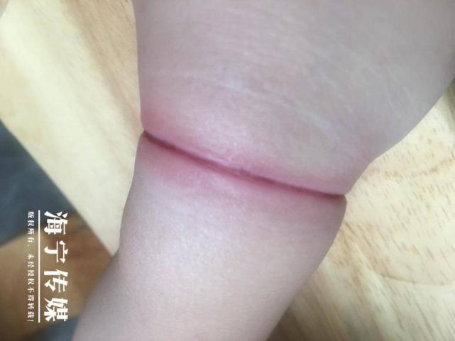 橡皮筋"闯祸" 2岁熊孩子皮筋戴手腕上 结果…_腾讯新闻