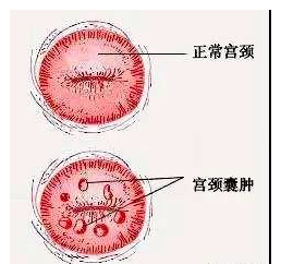 宫颈纳氏囊肿是什么