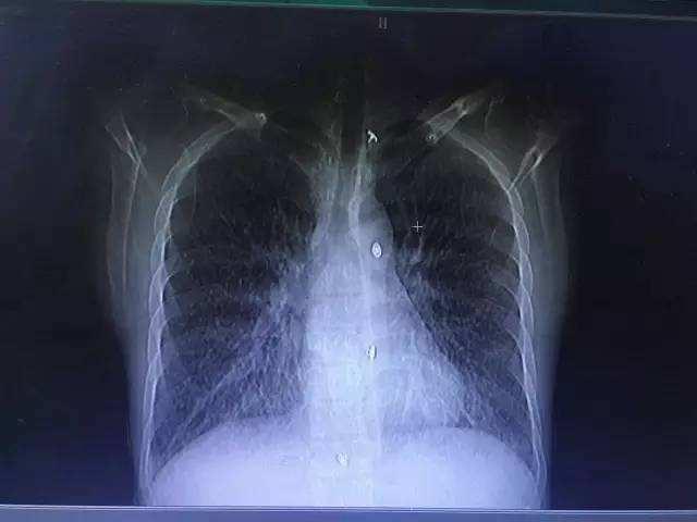抽烟肺部x光片图片