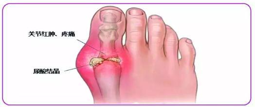 痛风多从这里开始痛,如果你也是,请尽早降下尿酸!