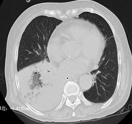 肺部感染ct怎么看看完这篇立刻入门