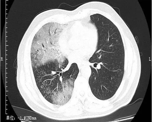 2 小叶性肺炎(支气管肺炎) 当病原体侵犯周围呼吸道上皮,引起支气管