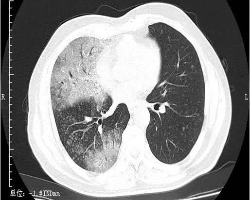 肺炎的早期症状ct图片图片