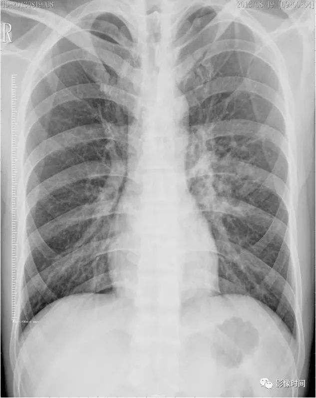 病例 1:同一小叶性肺炎患者于同日拍摄的胸片和肺 ct