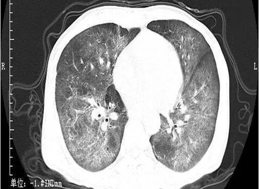 肺部感染 ct 怎么看?看完这篇立刻入门!_腾讯新闻