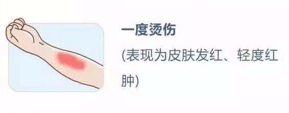 应急 不要再涂牙膏了 看完这里 教您科学应对烫烧伤