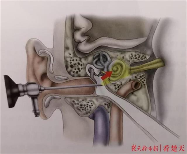 中年女聽力急速下降,原是長聽神經瘤,醫生用