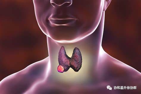 甲状腺癌科普系列(二十一):结节钙化就是甲状腺