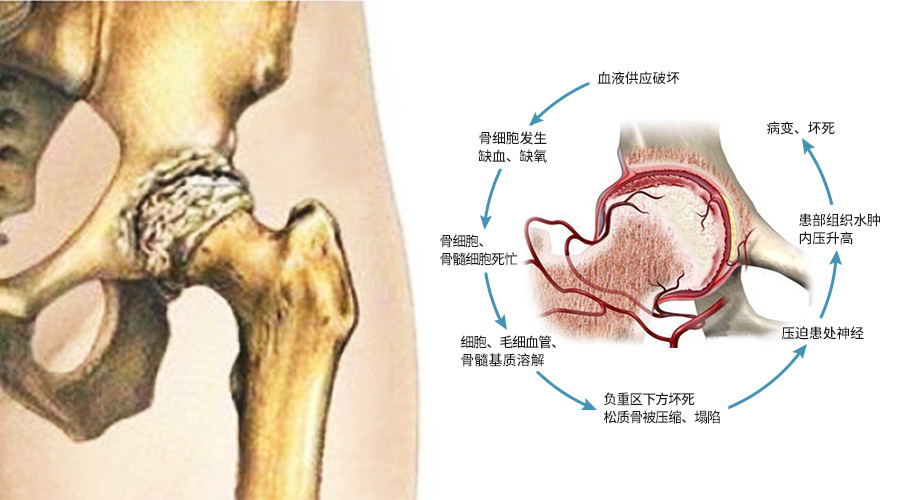 有責任的人才能治好股骨頭壞死疾病你行不行