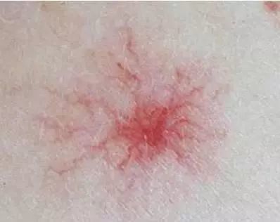 身上这些像 小红痣 的小点 还不痛不痒的 是怎么回事 腾讯新闻