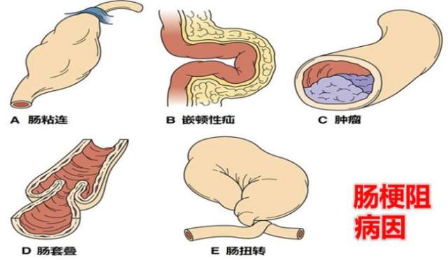 腸梗阻