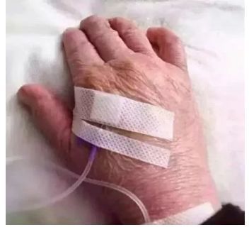 静脉穿刺|十种静脉穿刺新方法，对护士太实用了！