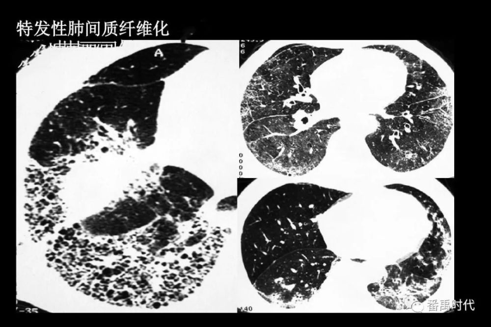 特发性肺间质纤维化的特点表现