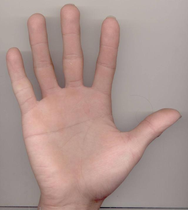 你的手指形状决定健康状况!