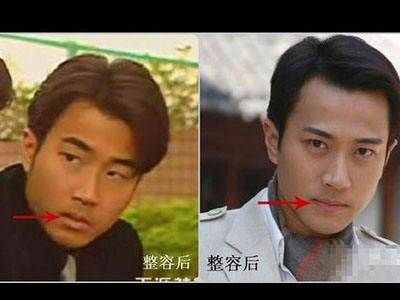 没有整容前的刘恺威是小单眼皮,后来割双眼皮开眼角,以及整了鼻子之后