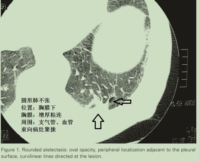 这种肺不张,极易误诊为"肿瘤"!