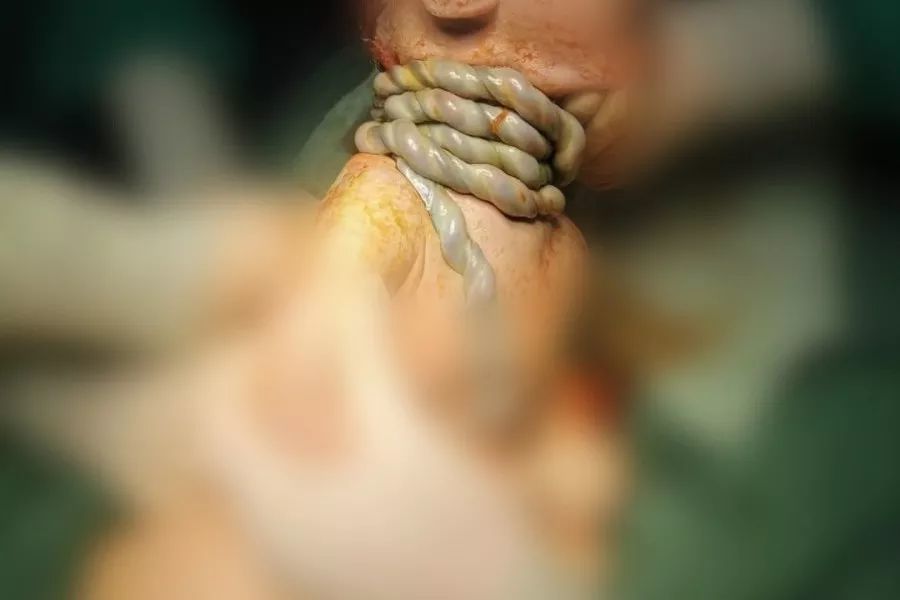 38周胎儿因脐带胎死宫内不是绕颈而是