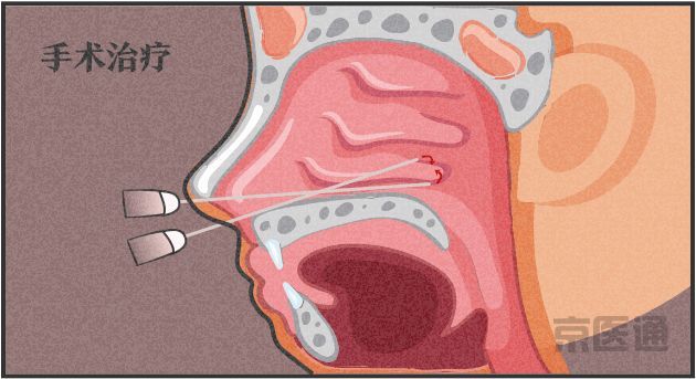 过敏性鼻炎能根治吗 这篇文章终于说透了 腾讯新闻