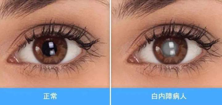 首大施玉英到底什么时候做白内障手术最好