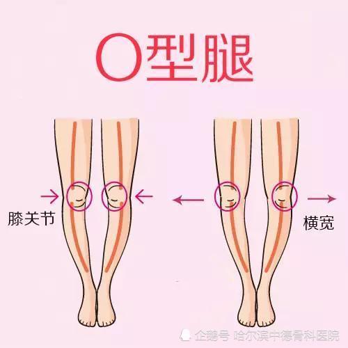 如何改善o型腿 这套方法教你 O型腿 罗圈腿
