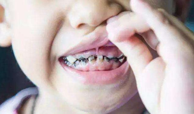 2岁宝宝还在用奶瓶不当用奶瓶导致龋齿低龄化