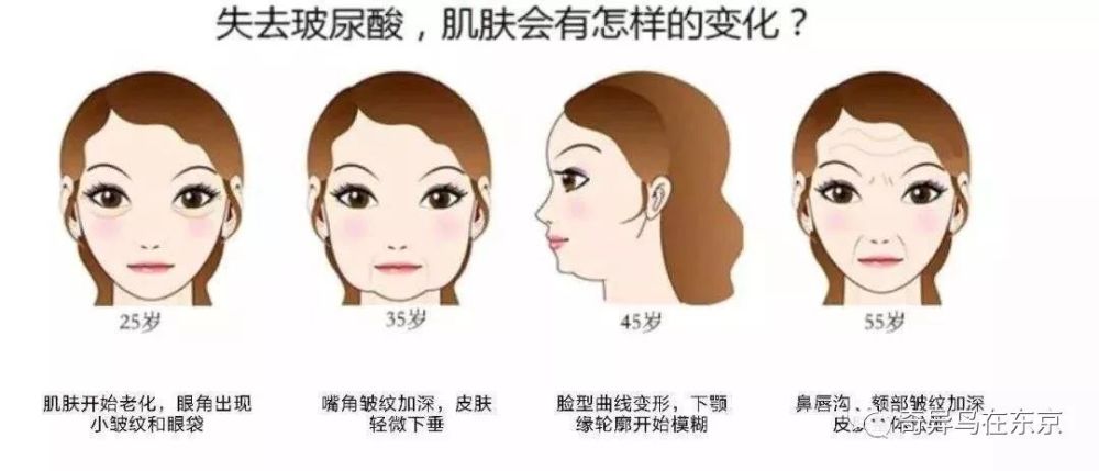 鼻唇沟纹怎么去除,去除鼻唇沟皱纹