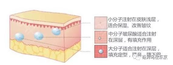 鼻唇沟纹怎么去除,去除鼻唇沟皱纹