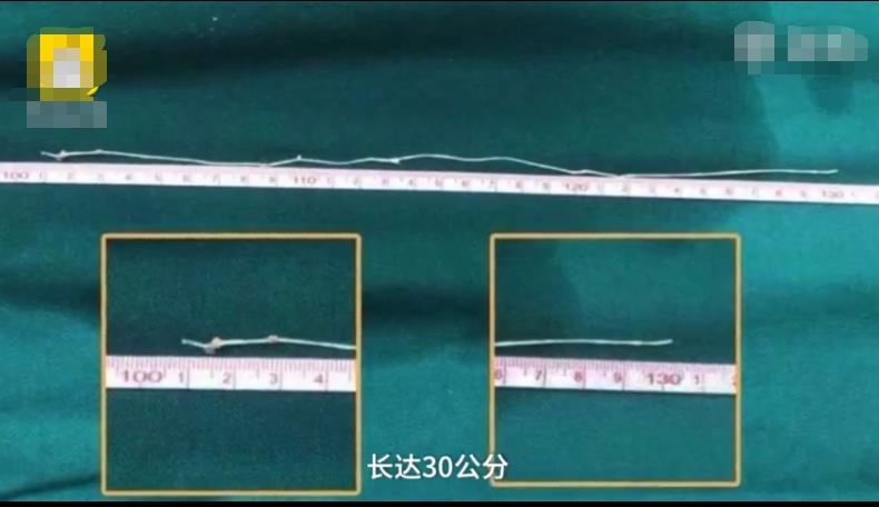 男子颅内取出30cm寄生虫 原来是饮食习惯所致 这些食物别再乱吃 腾讯新闻