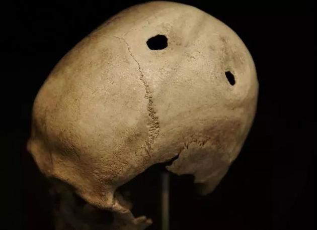 没有麻药和抗生素 古人竟然能做开颅手术 腾讯新闻