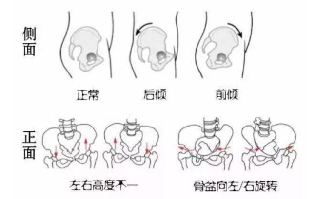 骨盆最常见的烦恼,就是"歪斜".