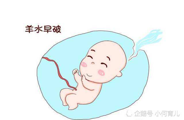 羊水早破对胎儿危害大不要慌了解这几点预防早产
