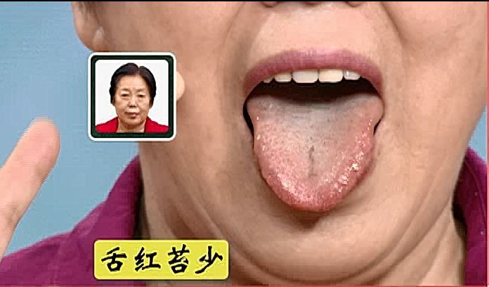 阴虚体质人群的舌象表现为舌红苔少.