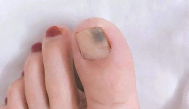 灰指甲怎么得的 医生提醒 3种治疗 一种最有效 保障指甲靓丽 腾讯新闻