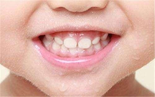 护理宝宝牙齿从零岁开始,不然真的会影响形象