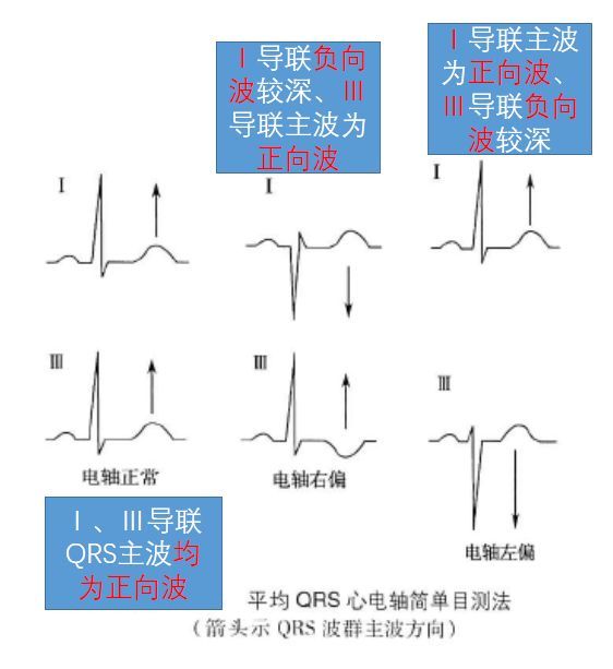 入门级心电图知识 心内科医生必备 腾讯新闻