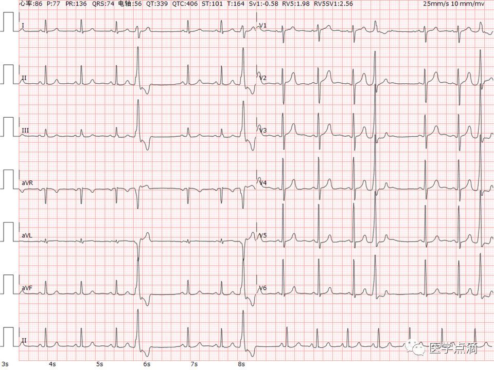 心电图知识学习,干货满满!送给需要的人