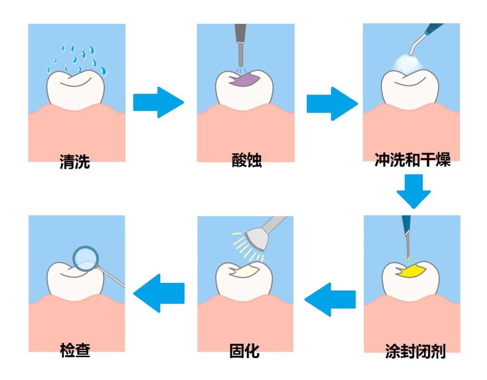 窩溝封閉示意圖窩溝封閉主要應用於乳磨牙,恆磨牙及恆前磨牙.