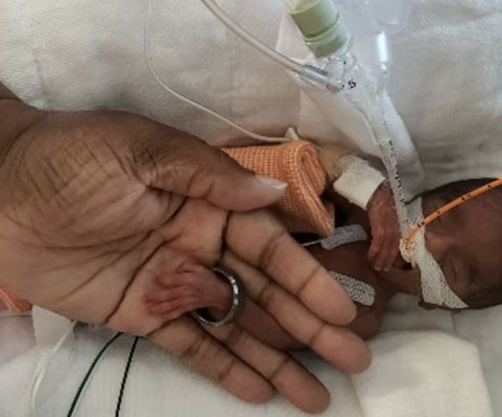 女婴出生时比芭比娃娃还小体重不足一斤奇迹般活了下来