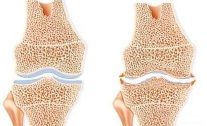 骨质疏松症患者越来越多,但对骨质疏松症的防治仍存在误区.